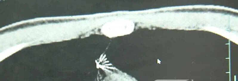 17岁小伙参军体检发现胸腔内有根5cm缝衣针<strong></p>
<p>虚拟货币是什么</strong>,父母回忆或是1岁时扎入,取出时已锈迹斑斑